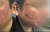 Tưởng mụn trứng cá hoá ra bệnh do ký sinh trùng gây ra