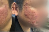 Tưởng mụn trứng cá hoá ra bệnh do ký sinh trùng gây ra