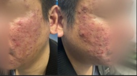 Tưởng mụn trứng cá hoá ra bệnh do ký sinh trùng gây ra